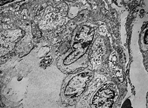 F,6m. | capillary hemangioma - hard palate F,6m. | capillary hemangioma - hard palate